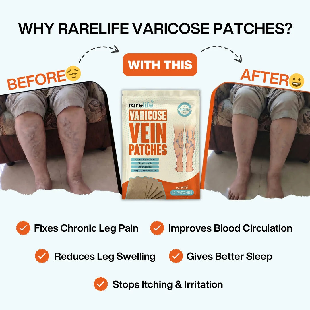 The Original Varicose Vein Relief Patches by RareLife