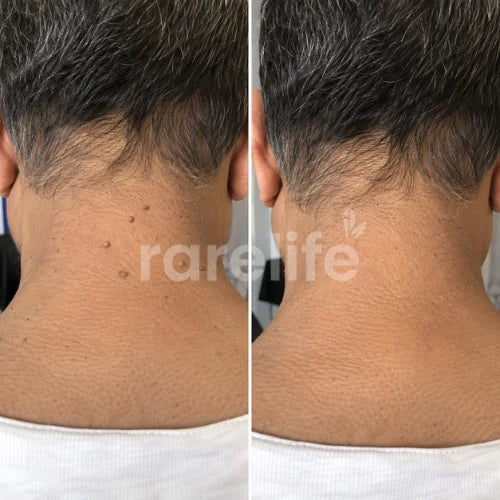 Rarelife Tarini | Skin Tag Removal Oil