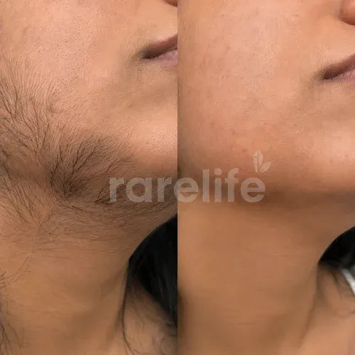 Rarelife Nivara Oil | Cyperus Rotundus